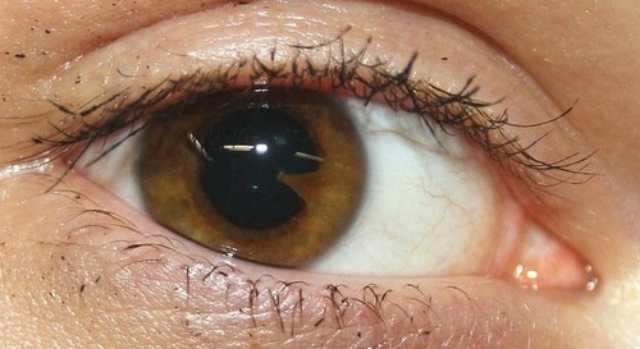 Лечение увеита глаз в клинике федорова