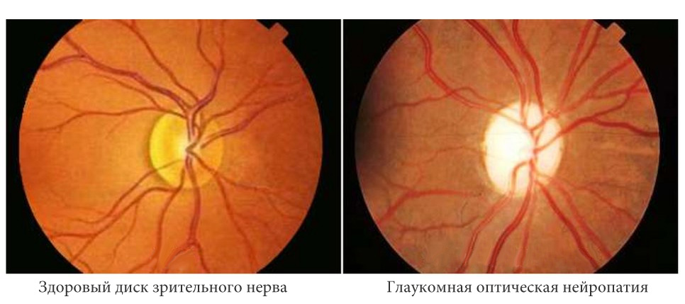 Тонкая роговица и глаукома