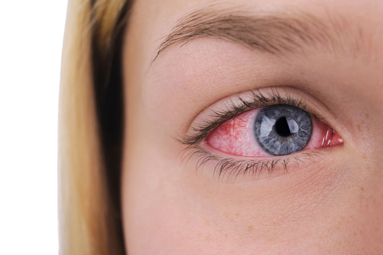 Покраснение глаз: причины и лечение
